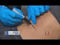 Doctor Discusses Turning An Outie Belly Button Into An Innie