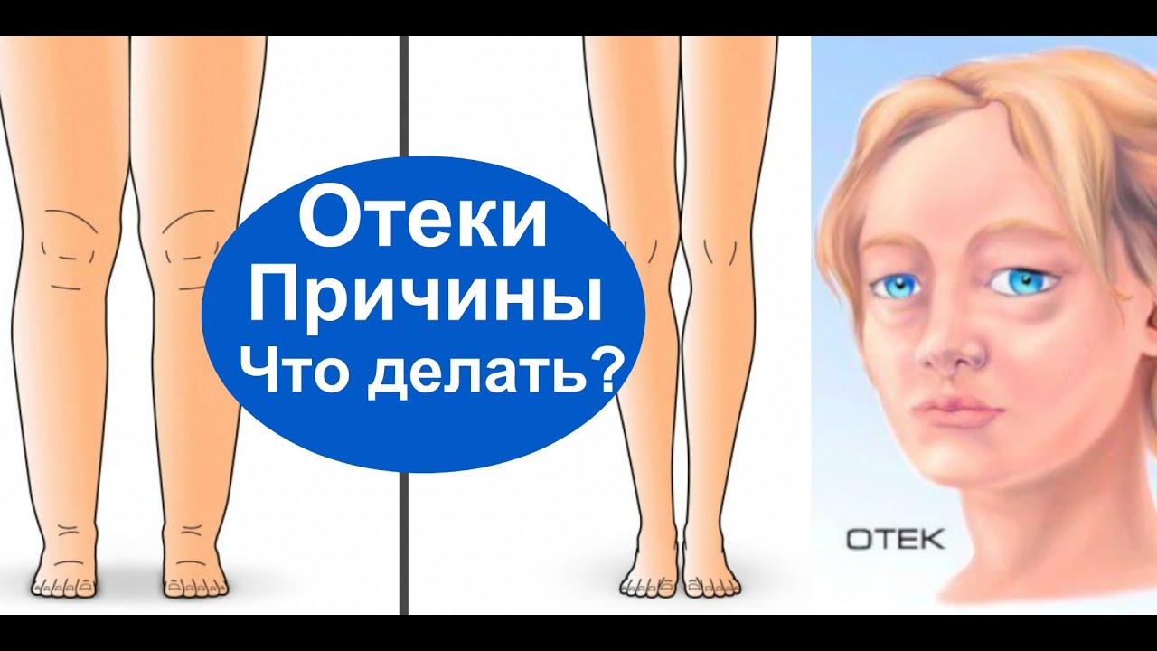 Отеки На Диете Что Делать