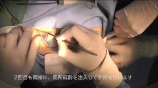 刺青分割切除(背部3回) 山本クリニック