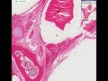 Histopathology Ovary--Benign teratoma