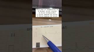 Ecg Diagnosis Dr Arvind Kumar