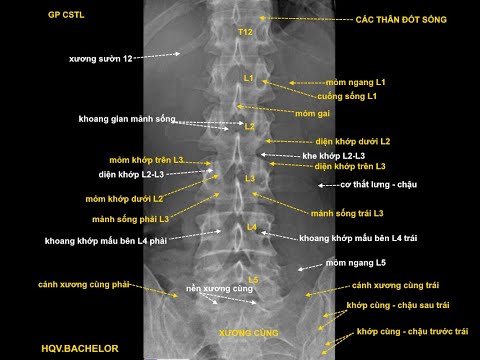 X quang cột sống thắt lưng thẳng