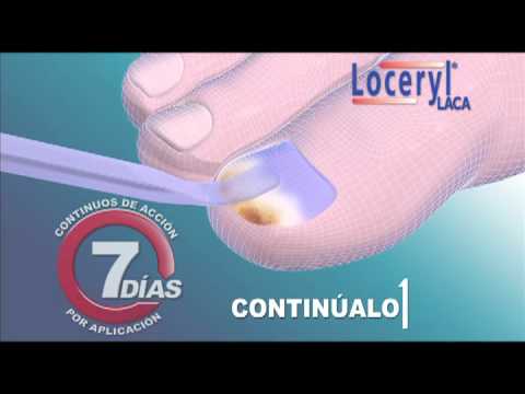 Cuántos días hacen el análisis al hongo las uñas