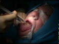 Base of Tongue Reduction for Severe Obstructive Sleep Apnea (GRAPHIC)