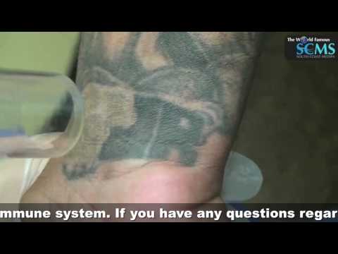 Pre-laser tattoo removal methods include dermabrasion, Laser Tattoo Removal Wrist
