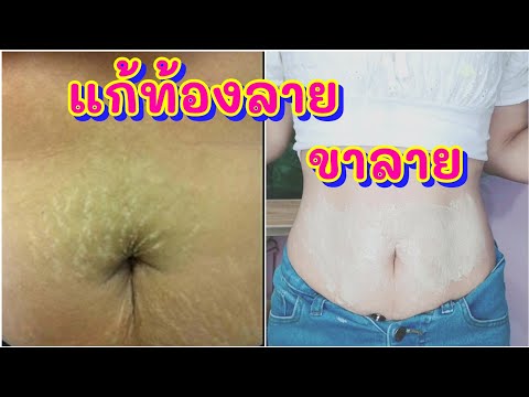 สูตรแก้ท้องลาย ขาลาย ทำทุกวัน เห็นผลชัดเจน📍แม่นายมาแชร์