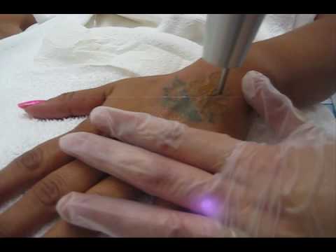 Tags: laser tattoo removal tattoo removal cost tattoo removal pricing tattoo 