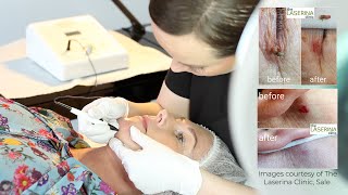 Hair Removal With Electrolysis. Which Machine Is Best?