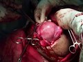 recurrent myoma with adhesion2
