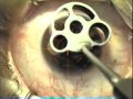 My Lasik Eye Surgery