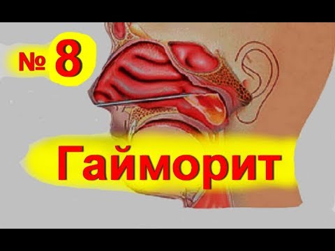 Гайморит эффективное лечение в домашних условиях Гайморит эффективное лечение в домашних условиях