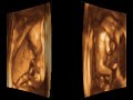 ultrasound 3d 4d