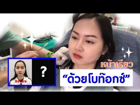 “ฉีดโบท๊อกซ์” Botox ลดกราม-หน้าเรียว