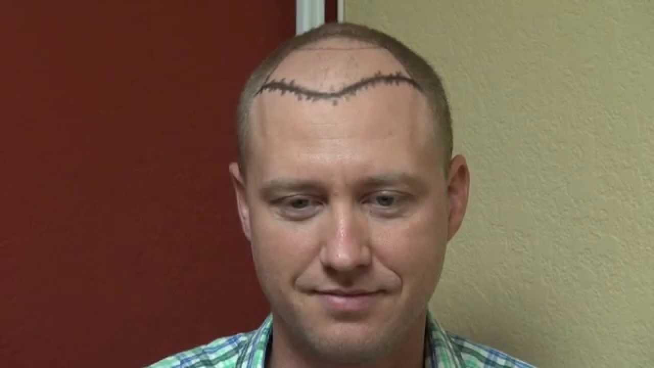 Forum on this topic: Bald Men Share How Hair Loss Has , bald-men-share-how-hair-loss-has/ Forum on this topic: Bald Men Share How Hair Loss Has , bald-men-share-how-hair-loss-has/