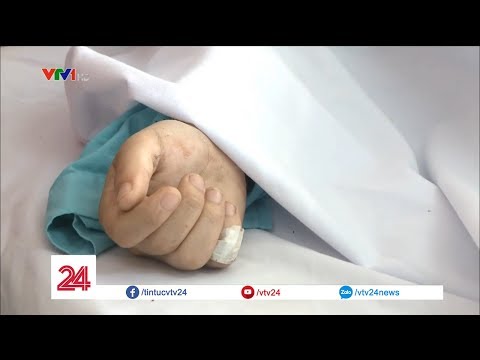 Nối liền cánh tay bị đứt cho nạn nhân tai nạn trên đèo Hải Vân | VTV24