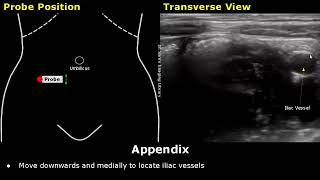 How To Scan Appendix Ultrasound Probe Positioning Transducer Placement Abdominal Usg Scanning