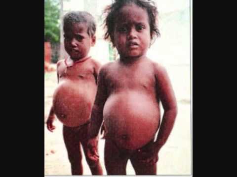 Kwashiorkor Diet Plan