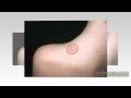 natural remedies for ringworm in humans