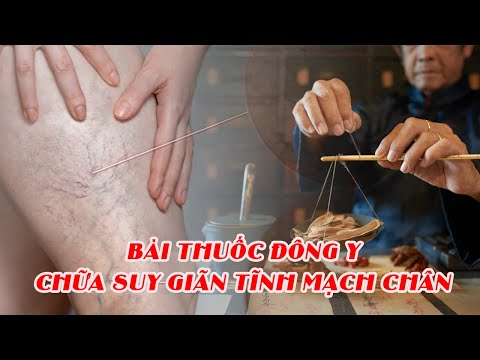 Bài thuốc đông y chữa suy giãn tĩnh mạch chân