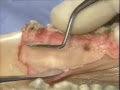 Introductory Periodontal Surgical Techniques: The Apically Positioned Flap and Crown Lengthening