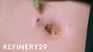 I Got The Belly On Piercing Removal Surgery Macro Beauty Refinery29