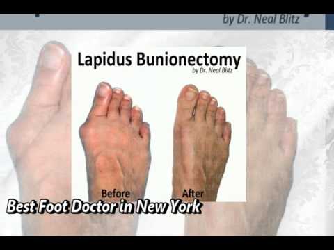 Tarsal Coalition Best Foot Doctor in New York