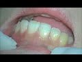 TOOTH!!