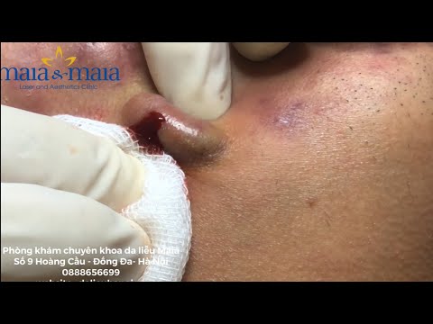 Nặn mụn trứng cá viêm nặng, mụn bọc, mụn mạch lươn nhiều mủ và cách trị mụn hiệu quả nhất tại PK Mai