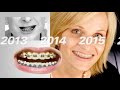 All About Six Month Smiles