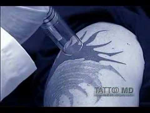 Tattoo removal - Dr. Alex Kaplan, Tattoo MD Laser Clinic in Los Angeles, 