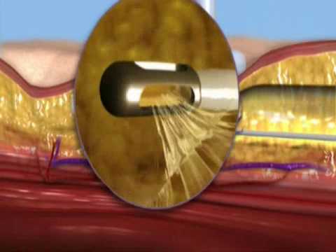 ripples after liposuction