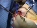 clavicular
