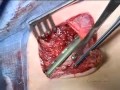 clavicular