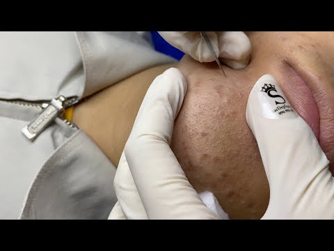 Chin Acne | Mụn Ẩn Ở Cằm - SacDepSpa#307