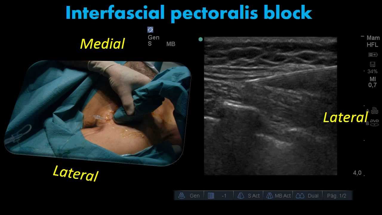 Ultrasound Interfascial pectoralis block - YouTube