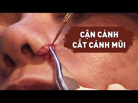 Cắt cánh mũi như thế nào? | Bs Mạnh