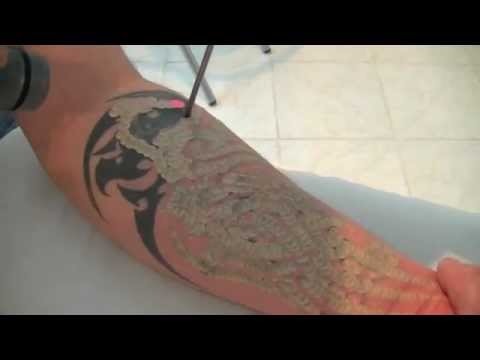 enlever les tatouages au laser, tattoo removal - YouTube