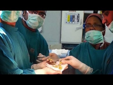 Gold Found in Man's Stomach! Gold Found in Man's Stomach! klip izle