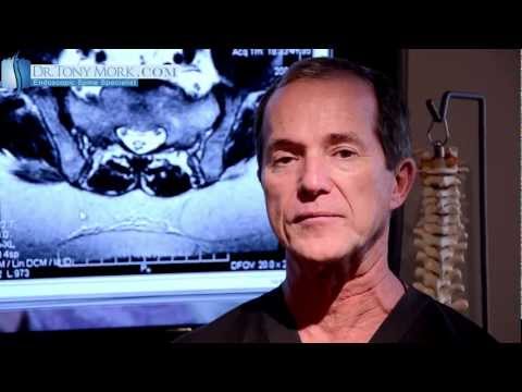 Endoscopic Spine Surgery Sacroiliac Syndrome by Dr. Tony Mork