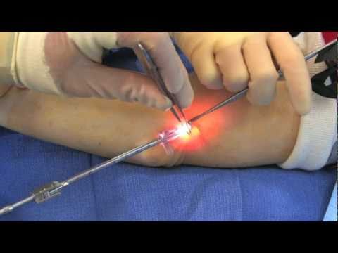Endoscopic Ulnar Nerve Decompression, Clear Cannula - YouTube
