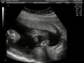 Our gender determination ultrasound