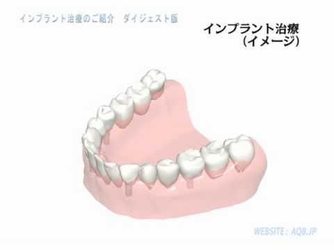 AQB.JP「AQBインプラント治療のご紹介」ダイジェスト版