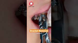 Bracket Removal