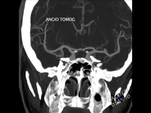 angio tc coronarica