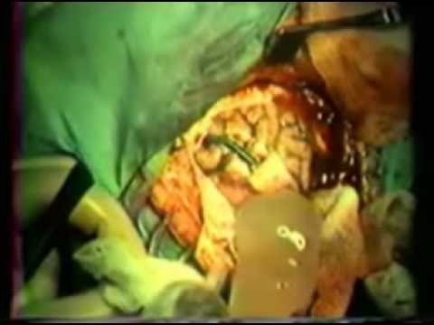 cirugía de cisticerco gigante en el cerebro