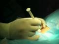 Ozonoterapia Discolisis cervical