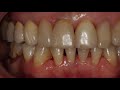 implanty zębów przed i po