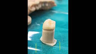 Zirconia Crown Digital Impressions Itero 5D Scan