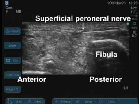 Ultrasound-Guided Phenol Injection into the superficial Peroneal Nerve