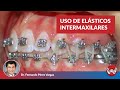 Uso de Elásticos Intermaxilares